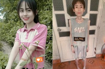 Cô g.ái Hưng Yên nặng 18kg sau nhiều năm kh.ông ăn cơm để g.iảm cân