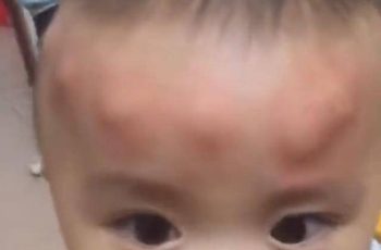 Con trai 2 tuổi ngủ dậy trên đầu liền xuất hiện nhiều khối u bất thường, người mẹ tá hoả khi biết nguyên nhân