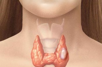 Số lượng u tuyến giáp ngày càng tăng nhanh, bác sĩ khuyên nên ăn ít hơn loại thực phẩm này