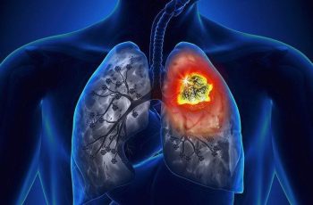 9 dấu hiệu UT phổi giai đoạn đầu bạn không nên bỏ qua
