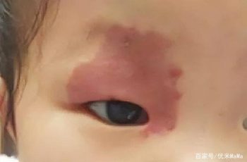 3 hành vi khi mang thai có thể gây ra vết bớt cho con, mẹ cố gắng tránh để con khỏi mặc cảm