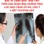 Bác sĩ cảnh báo: Ung thư phổi giai đoạn đầu không phải lúc nào cũng có ho, chú ý 4 bất thường này