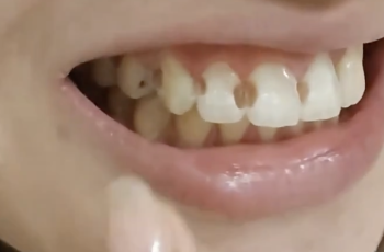 Đeo niềng 5 năm, cô gái phát hiện 8 răng bị thủng lỗ