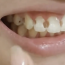 Đeo niềng 5 năm, cô gái phát hiện 8 răng bị thủng lỗ