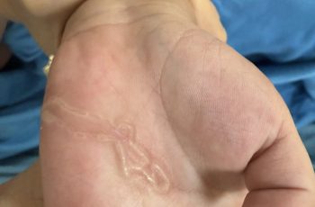 Bàn tay bé trai xuất hiện dấu hiệu lạ sau lần nghịch cát