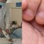 Thường xuyên cắn móng tay, bé 9 tuổi nhập viện phẫu thuật ba lần mới qua khỏi, mẹ ray rứt vì ngỡ bình thường