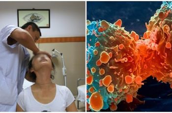 Người sắp bị UT thường có 3 dấu hiệu ở cổ, đi khám sớm còn cơ hội điều trị