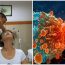 Nếu có polyp trong ru:ột, khi đi vệ sinh sẽ có 4 dấu hiệu này, đi khám ngay kẻo muộn
