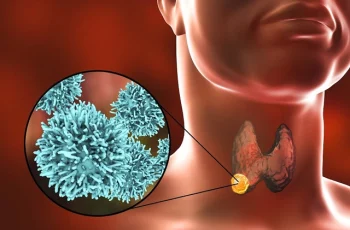 Cảnh báo: U tuyến giáp lành tính mà gặp dấu hiệu này là phải đi khám gấp