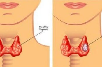 Khi UT vòm họng ban đầu “ghé thăm”, cơ thể có thể phát đi 3 “tín hiệu” đỏ, cố gắng đừng phớt lờ