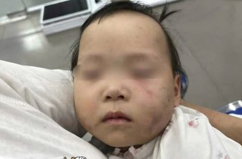 Bé gái 1 tuổi bị bầm tím mặt khi gửi nhà trẻ ở Bắc Ninh: Công an tạm giữ cô giáo