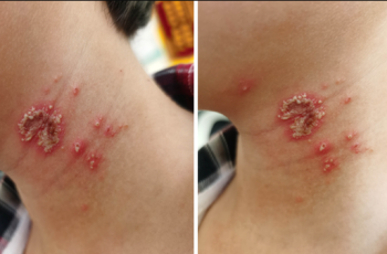 Bé trai 10 tuổi bỗng xuất hiện những nốt mẩn lạ trên da nhưng vẫn chưa tìm ra được nguyên nhân