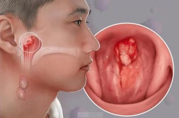 7 dấu hiệu K vòm họng: Số 1 không biết sớm khó mà chữa