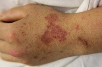 TP.HCM cảnh báo bệnh cực nguy hiểm, có thể gây tuvong chỉ sau vài giờ