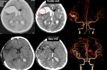TP.HCM: Bé gái 13 tuổi đôt quy, xuat huyet não, sốc tim khi đang ngủ