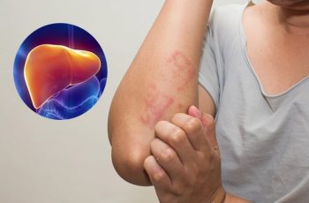 7 dấu hiệu cảnh báo bệnh gan đã đi vào giai đoặn nặng