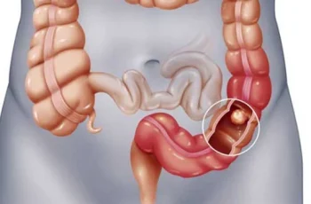 Cảnh báo dấu hiệu khi đi ngoài chứng tỏ cơ thể đã bị ung thư đại tràng, cần đi khám gấp Cảnh báo dấu hiệu khi đi ngoài chứng tỏ cơ thể đã bị ung thư đại tràng, cần đi khám gấp