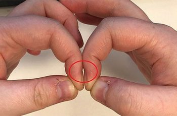 Đặt 2 đầu ngón tay trỏ sát nhau, đoán ngay mình có bị ung thư phổi hay không Đặt 2 đầu ngón tay trỏ sát nhau, đoán ngay mình có bị ung thư phổi hay không