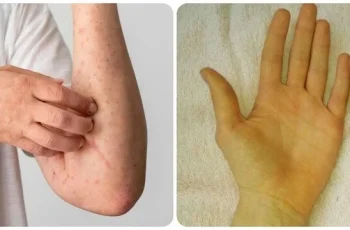 9 dấu hiệu UT gan giai đoạn đầu rất dễ nhầm với bệnh lý khác 9 dấu hiệu UT gan giai đoạn đầu rất dễ nhầm với bệnh lý khác