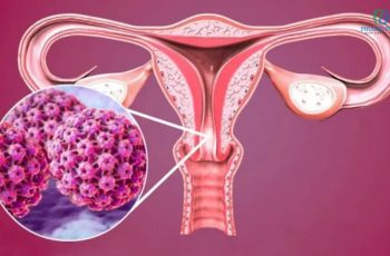 Người vợ 38 tuổi bị UT cổ tử cung vì chiều theo “sở thích” của chồng: Dù yêu chồng đến mấy vẫn cần tỉnh táo Người vợ 38 tuổi bị UT cổ tử cung vì chiều theo “sở thích” của chồng: Dù yêu chồng đến mấy vẫn cần tỉnh táo