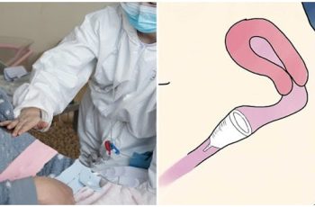 Cô gái suy kiệt vì ‘chiếc cốc’ nằm im 7 tháng, đi viện không lấy được: Cảnh báo cho chị em Cô gái suy kiệt vì ‘chiếc cốc’ nằm im 7 tháng, đi viện không lấy được: Cảnh báo cho chị em