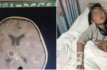 Bé gái lớp 2 não “bị ăn mòn chục lỗ”, chậm chút là rỗng hoàn toàn: Thủ phạm rất phổ biến trong mọi gia đình Bé gái lớp 2 não “bị ăn mòn chục lỗ”, chậm chút là rỗng hoàn toàn: Thủ phạm rất phổ biến trong mọi gia đình