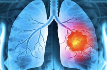 Bác sĩ chỉ ra 5 dấu hiệu cảnh báo ung thư phổi dễ bị phớt lờ Bác sĩ chỉ ra 5 dấu hiệu cảnh báo ung thư phổi dễ bị phớt lờ