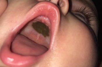 Mẹ phát hoảng thấy miệng con xuất hiện đốm đen lạ, đến bệnh viện nghe bác sĩ chúc mừng mà xấu hổ Mẹ phát hoảng thấy miệng con xuất hiện đốm đen lạ, đến bệnh viện nghe bác sĩ chúc mừng mà xấu hổ