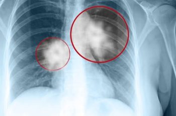 Các bác sĩ cho biết: Ung thư phổi giai đoạn đầu không gây đau ngực mà là 4 bất thường này Các bác sĩ cho biết: Ung thư phổi giai đoạn đầu không gây đau ngực mà là 4 bất thường này
