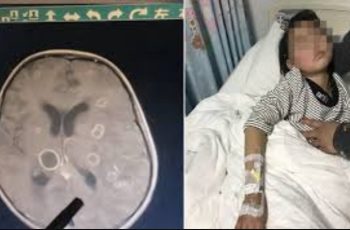 Bé gái lớp 2 não “bị ăn mòn chục lỗ”, chậm chút là rỗng hoàn toàn: Thủ phạm rất phổ biến trong mọi gia đình Bé gái lớp 2 não “bị ăn mòn chục lỗ”, chậm chút là rỗng hoàn toàn: Thủ phạm rất phổ biến trong mọi gia đình