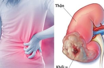 Ung thư thận là bệnh ác tính nguy hiểm, tỷ lệ tử vong cao nhưng các triệu chứng thường âm thầm, khiến người bệnh dễ chủ quan và bỏ lỡ thời điểm vàng điều trị. Ung thư thận là bệnh ác tính nguy hiểm, tỷ lệ tử vong cao nhưng các triệu chứng thường âm thầm, khiến người bệnh dễ chủ quan và bỏ lỡ thời điểm vàng điều trị.