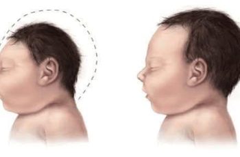 ‘Sát thủ’ gây teo não ở trẻ mà bố mẹ vẫn cho con ăn hàng ngày mà không lường trước hậu quả ‘Sát thủ’ gây teo não ở trẻ mà bố mẹ vẫn cho con ăn hàng ngày mà không lường trước hậu quả